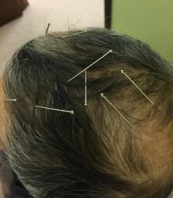 Neuro-Acupuncture