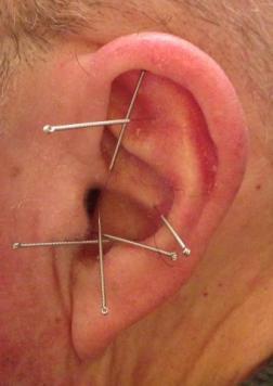 Ear acupuncture for loss of taste