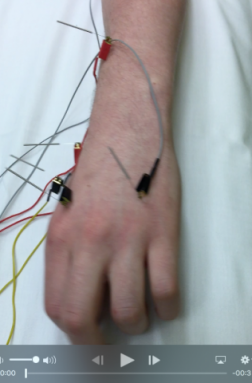 Acupuncture with electrical stimulation for paralysis