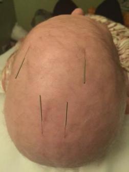 Scalp Acupuncture Treats Pain