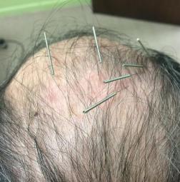 Neuro-Acupuncture for Stroke
