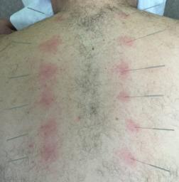 acupuncture for back pain