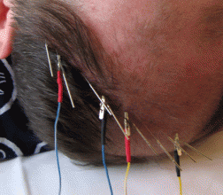 Post-stroke therapy with scalp acupuncture