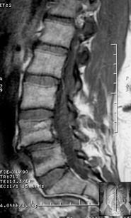 Spondylolisthesis at L4 & L5