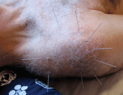 Local needling promotes healing. For patients who don't like needles, acupressure can be just as effective.